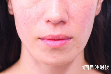 医療法人秀晄会 心斎橋コムロ美容外科クリニックの痩身、メディカルダイエットの症例写真[ビフォー]