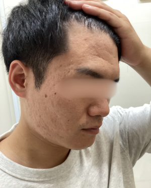 ニキビ跡の治療(ダーマペンエクソソーム、ACRS)の症例写真[ビフォー]