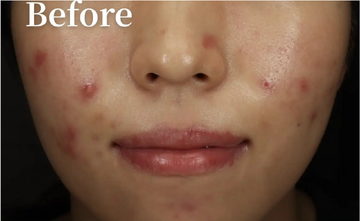 CLINIC Wのニキビ・ニキビ跡の治療の症例写真[ビフォー]