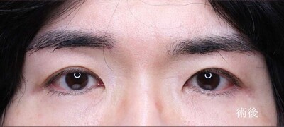 眼瞼下垂手術＋眉下リフトで凛々しい目元に（男性）の症例写真[アフター]