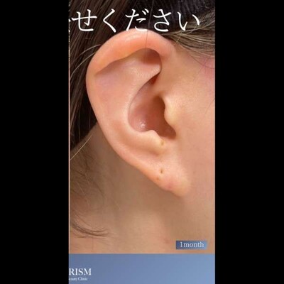 耳垂裂修正も当院にお任せください👏🏻の症例写真[アフター]