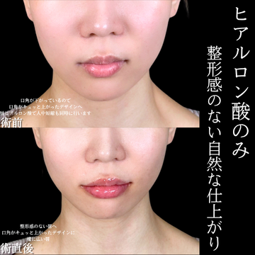 アリエル美容クリニック 大宮院の口元・唇の整形・人中短縮の症例写真