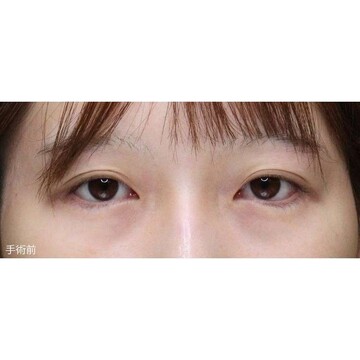 聖心美容クリニックの二重の症例写真[ビフォー]