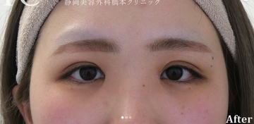 静岡美容外科橋本クリニックの症例写真[アフター]