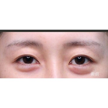 聖心美容クリニックの二重の症例写真[ビフォー]