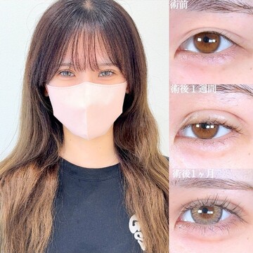 アリエル美容クリニック 大宮院の二重の症例写真