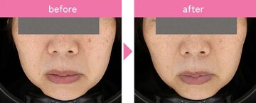 タイムルクリニックのシミ・肝斑の症例写真