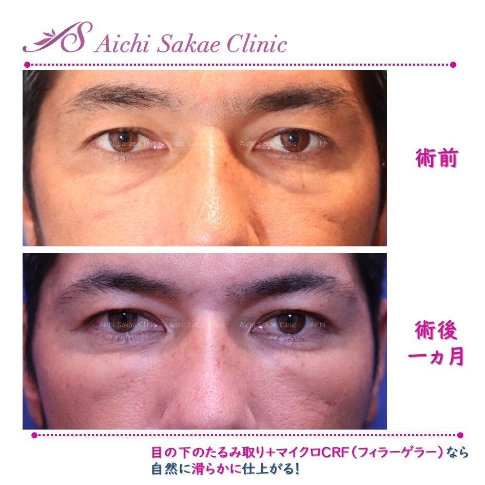 目元の印象で見た目年齢は大きく変わる しわ たるみ整形 注入 糸 フェイスリフト の症例写真 画像 あいち栄クリニック Cs 美容医療の口コミ広場
