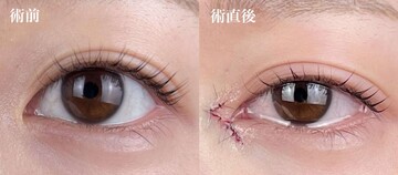 AI Beauty Clinicの二重の症例写真[ビフォー]