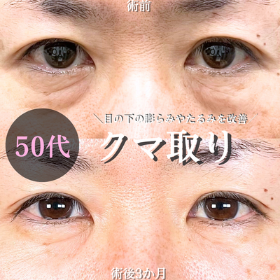 目の下のたるみ取り・クマ取り/脂肪注入の症例写真