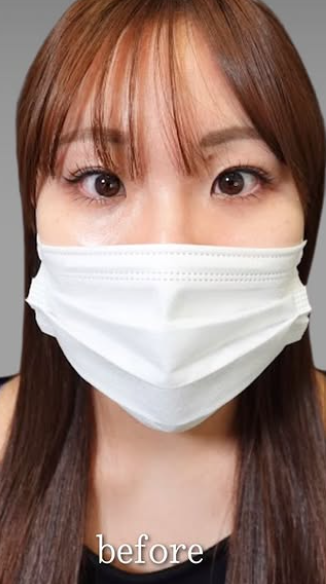 Plume Clinicの目元・クマ・眉下・涙袋整形の症例写真[ビフォー]