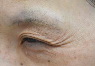 しわボトックス（目尻）の症例写真[ビフォー]