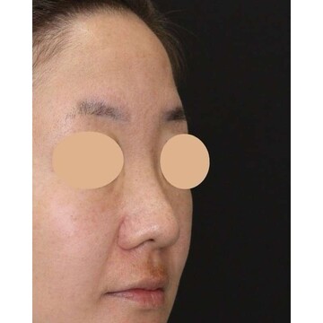 聖心美容クリニックの鼻の症例写真[ビフォー]