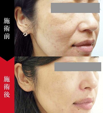 椿クリニックのシミ取り・肝斑・毛穴治療の症例写真