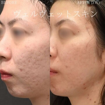 豊洲内科・糖尿病／形成・美容外科クリニックのニキビの症例写真