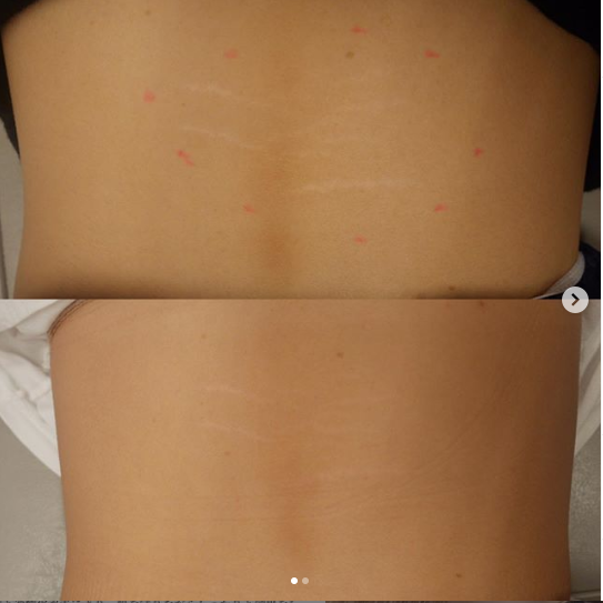 背中の肉割れ治療 肉割れ 妊娠線の治療の症例写真 画像 恵比寿美容クリニック Cs 美容医療の口コミ広場