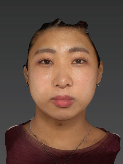 鼻尖縮小+鼻翼縮小の症例写真[アフター]