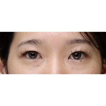 聖心美容クリニックの二重の症例写真[ビフォー]