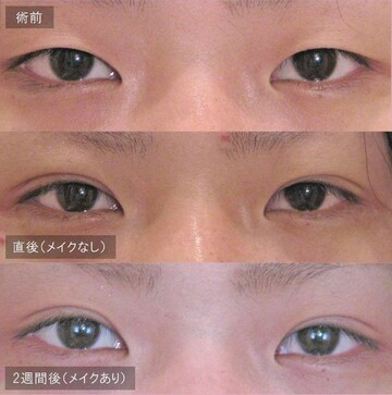 アーティスクリニックの目・二重整形の症例写真