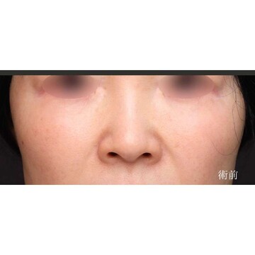 聖心美容クリニックの鼻の症例写真[ビフォー]