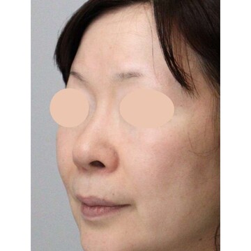 聖心美容クリニックの鼻の症例写真[ビフォー]