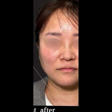 PRISM Beauty Clinicの症例写真[アフター]