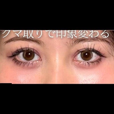 クマがないとこんなに印象が変わります💡の症例写真[アフター]