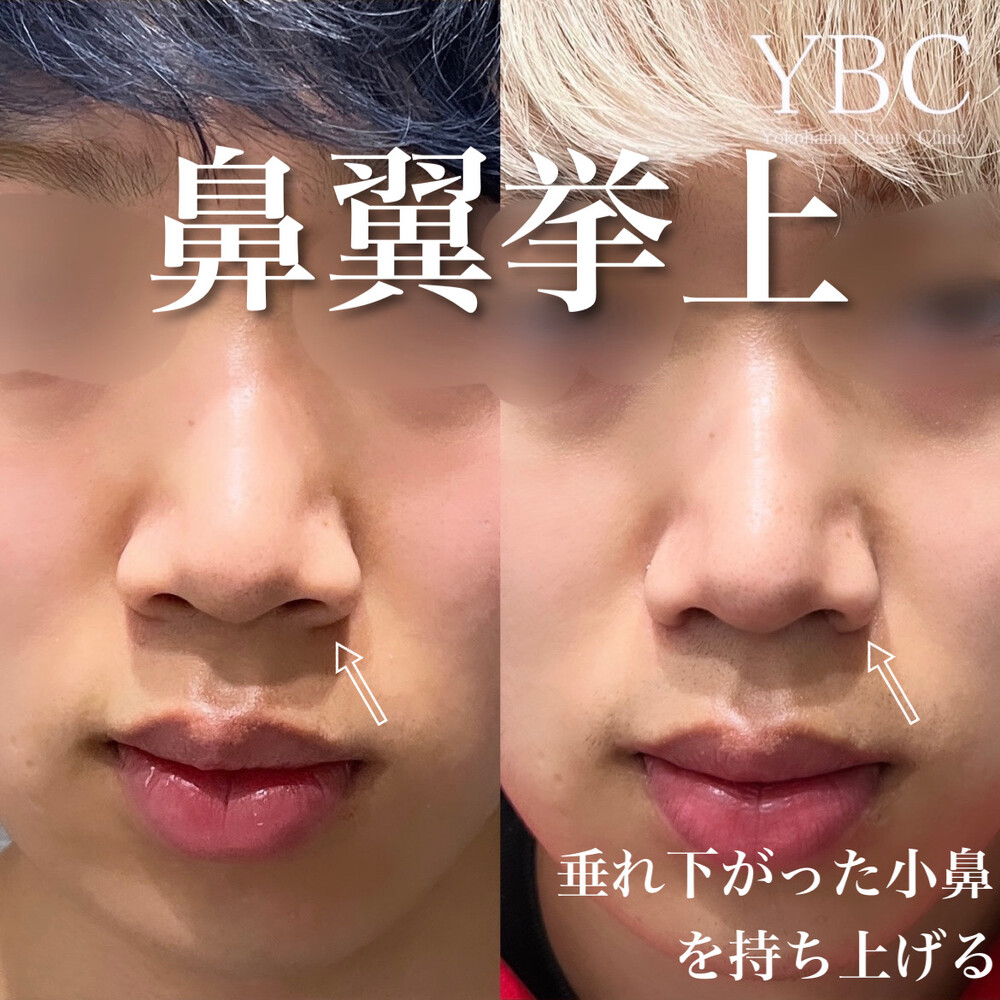 鼻翼 