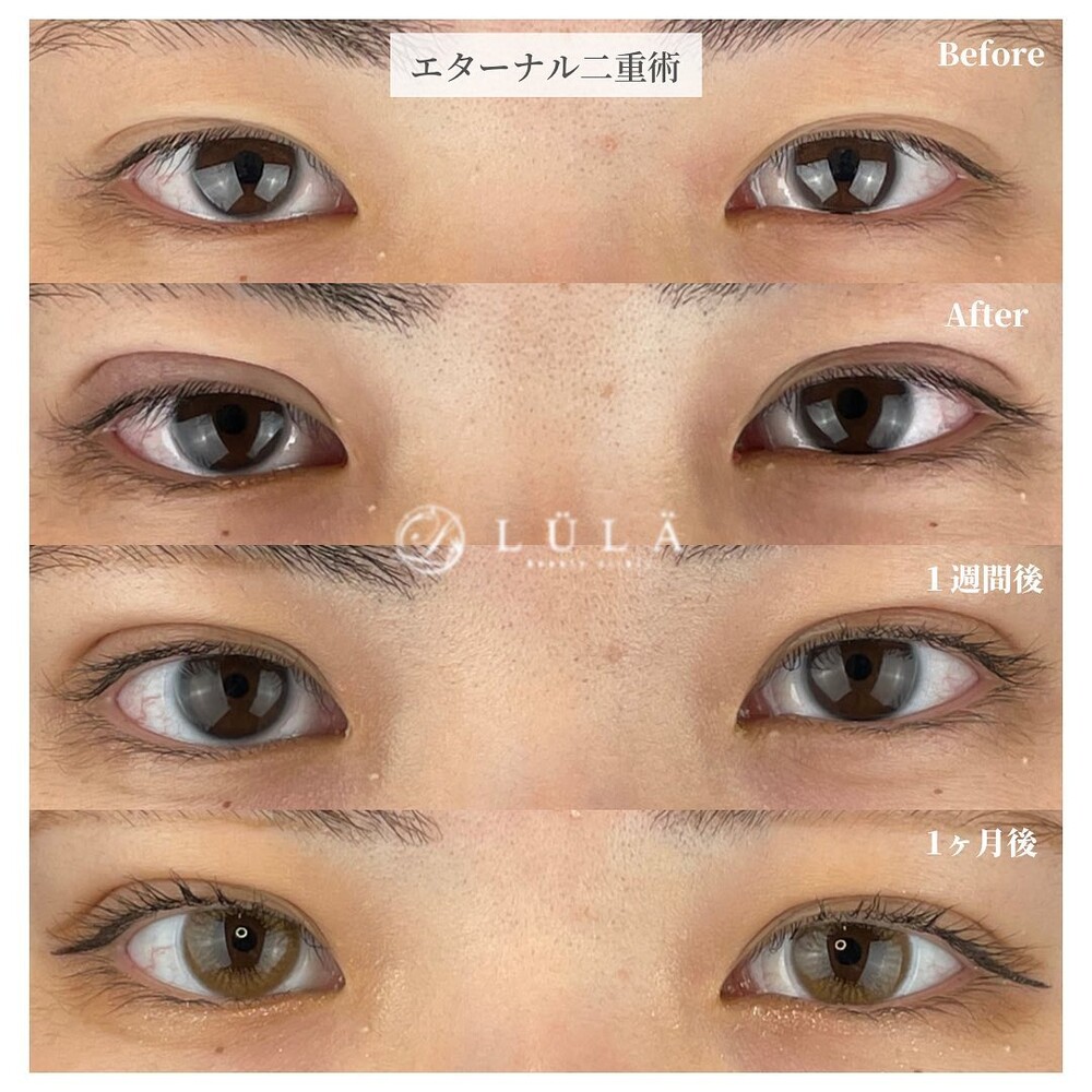 20代 女性] エターナル二重術（目・二重整形）の症例写真 (CS67311)｜ルラ（LULA）美容クリニック《美容医療の口コミ広場》