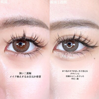 アリエルクイックループダブル二重埋没法の症例写真