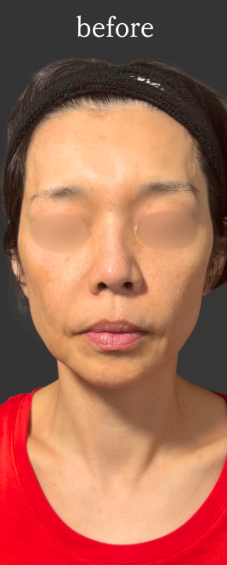 Plume Clinicのしわ・たるみ整形(注入、糸、フェイスリフト)の症例写真[ビフォー]