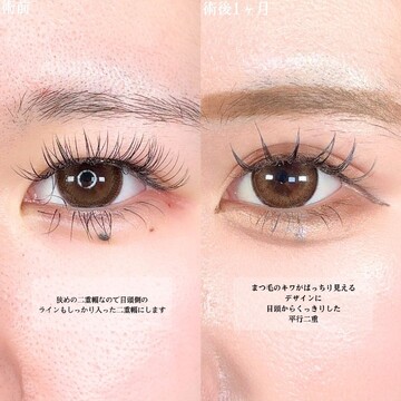 アリエル美容クリニック 大宮院の二重の症例写真