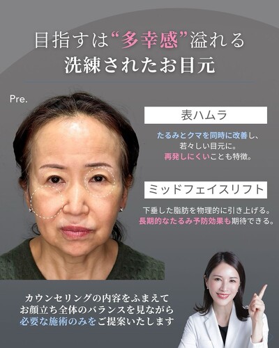 70代から始めるクマ治療の症例写真