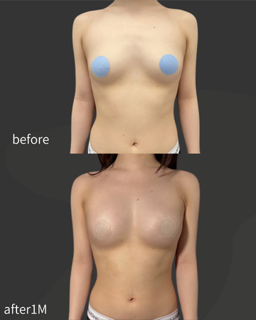 Plume Clinicの豊胸・胸の整形の症例写真