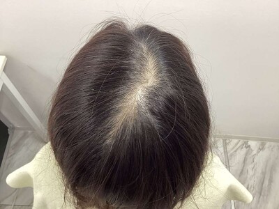 ヘアアートメイク｜50代｜2回の症例写真[ビフォー]