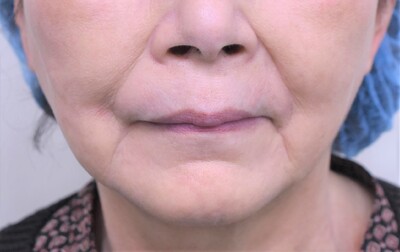 70代　女性　バイニードルリフト　8本の症例写真[ビフォー]