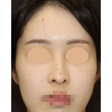 聖心美容クリニックの鼻の症例写真[ビフォー]