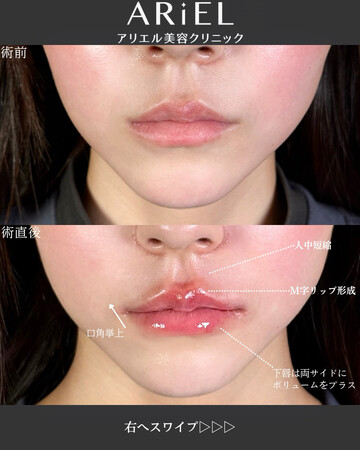 アリエル美容クリニック 郡山院の口元・唇の整形・人中短縮の症例写真