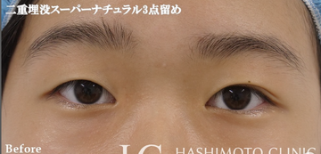 静岡美容外科橋本クリニックの二重の症例写真[ビフォー]