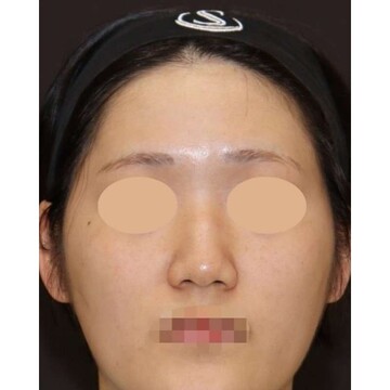 聖心美容クリニックの鼻の症例写真[ビフォー]