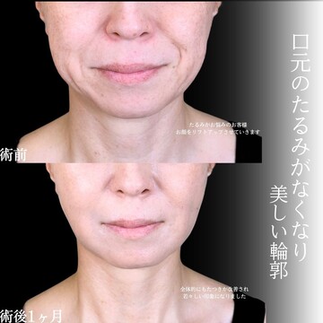 アリエル美容クリニック 大宮院の脂肪吸引の症例写真