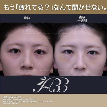 あいちビューティークリニック栄本院の目元・クマ・眉下・涙袋整形の症例写真