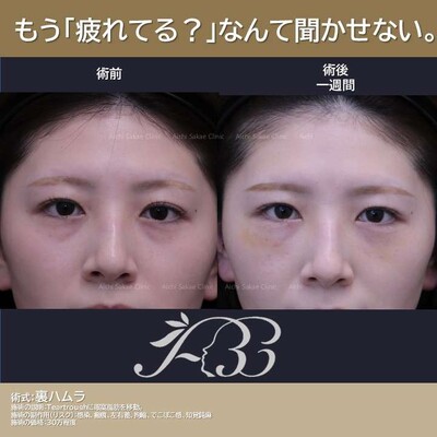 裏ハムラ単独でもここまで治る。（透け感は残る）の症例写真