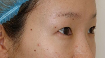 すなおクリニックの二重の症例写真[ビフォー]