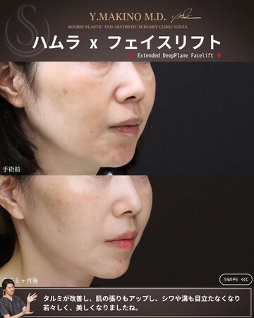 聖心美容クリニックのしわ・たるみ整形(注入、糸、フェイスリフト)の症例写真