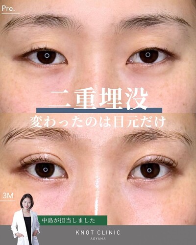 二重埋没3点法の症例写真