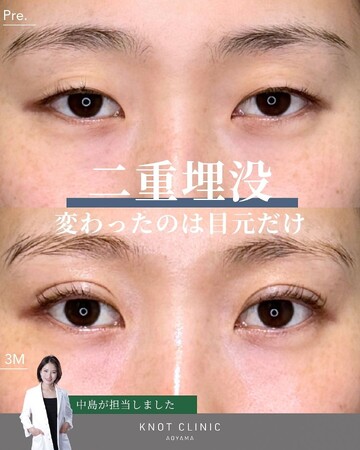 KNOT CLINIC AOYAMAの二重の症例写真
