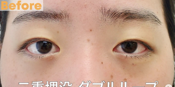 さかえ皮フ科クリニック（旧：ニドークリニック名古屋）の目・二重整形の症例写真[ビフォー]