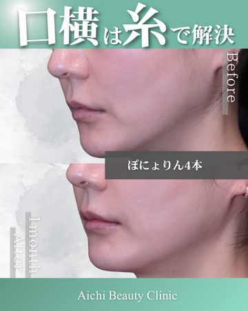 あいちビューティークリニック栄本院のリフトアップの症例写真