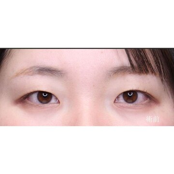 聖心美容クリニックの二重の症例写真[ビフォー]